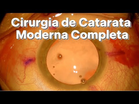 Cirurgia de Catarata Moderna Completa