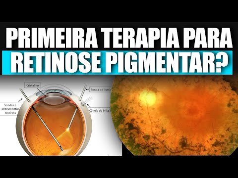 Primeiro Tratamento para Retinose Pigmentar?