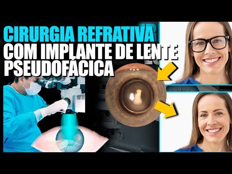 Cirurgia Refrativa com Implante de Lente Intraocular Pseudofácica na Íntegra