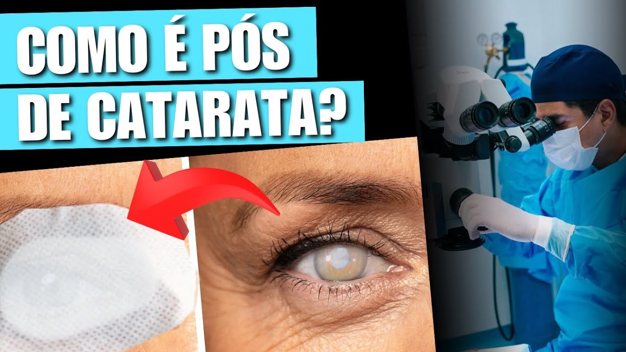 Pós-operatório da Cirurgia de Catarata: Tudo o que Você Precisa Saber