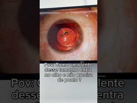 Vc já sabia que é assim que uma lente desse tamanho entra dentro do olho?