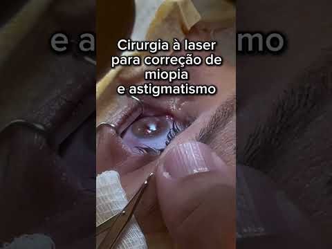 Cirurgia à laser para correção de miopia e astigmatismo