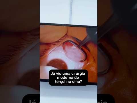 Calázio: cirurgia na íntegra