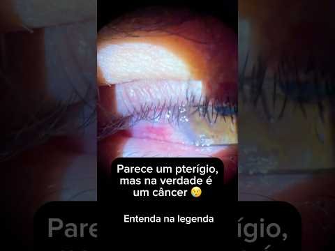 Carne no olho: câncer ou Pterígio?